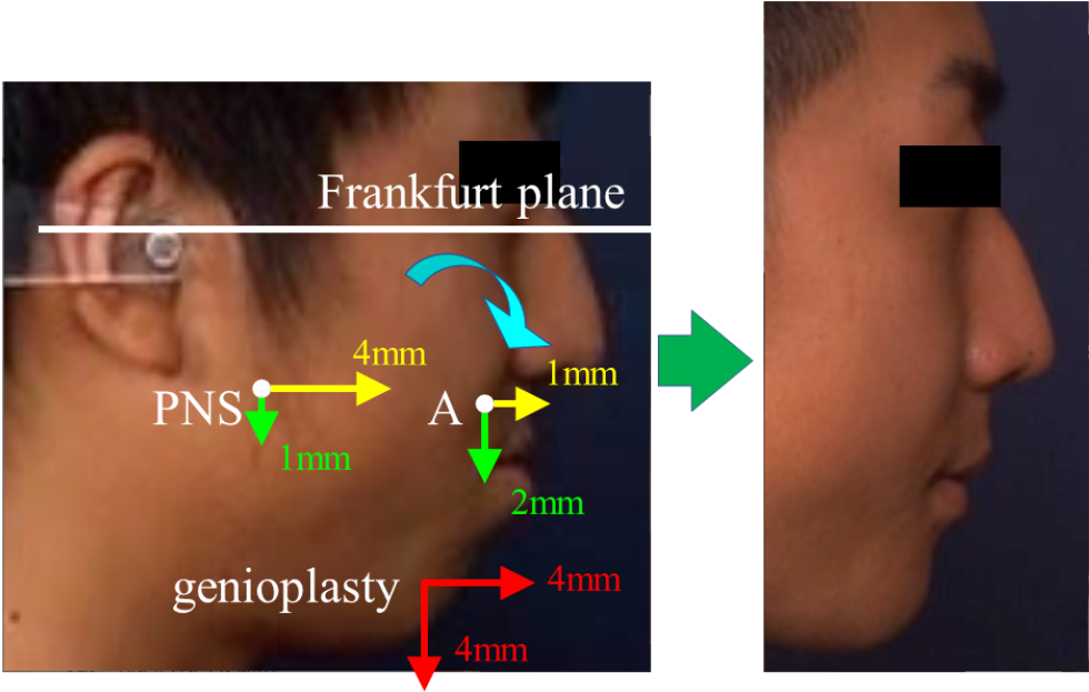 An example cephalometric images before and after the surgery with maxillary impaction with sliding genioplasty [7].