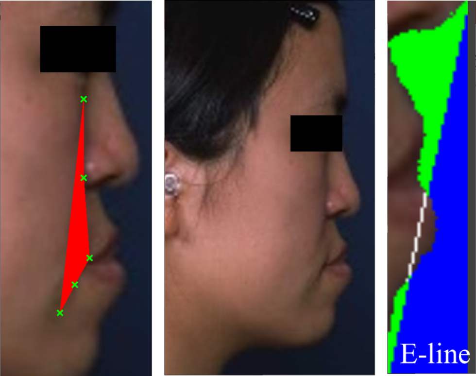 The regions of interest, i.e. cheek region (indicated by red mesh to the left) which is a skin region surrounded by five points along cheek bulge, and E-region (green mesh to the right) which is the background of face surrounded by aesthetic line (E-line) and skin region.